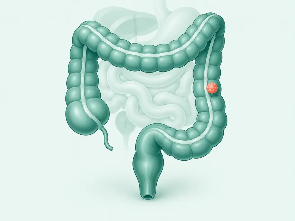 Ilustrasi editorial usus besar dengan satu area tumor pada dinding kolon